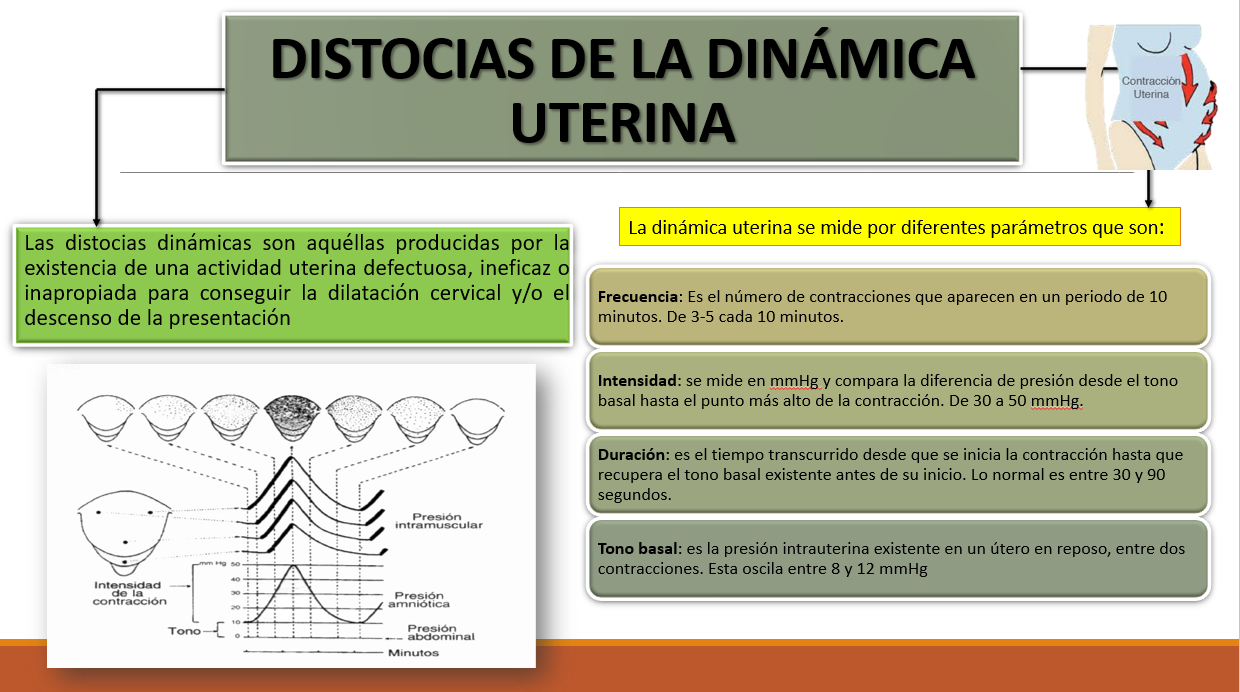 Distocias De La Dinámica Uterina - PPT