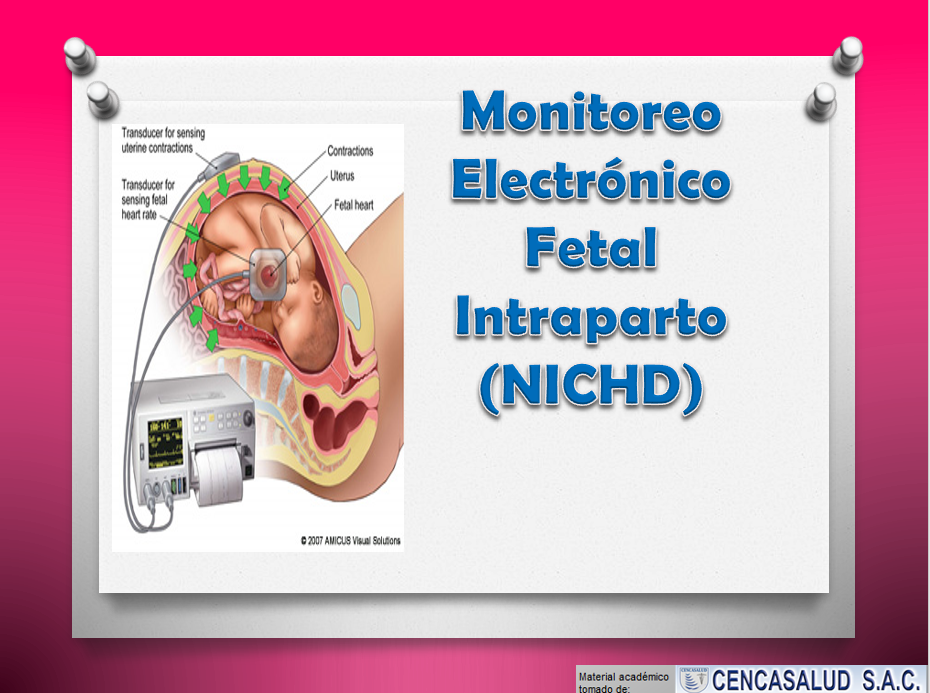 Monitoreo Electrónico fetal Intraparto - PPT