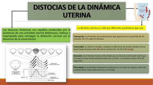 Distocias De La Dinámica Uterina - PPT
