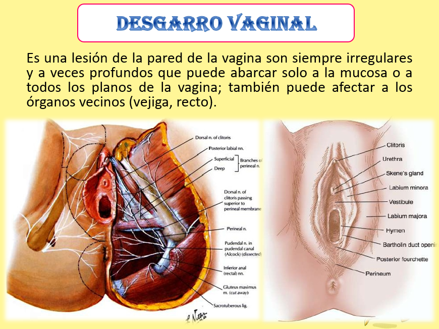 Desgarro Perineal, Cervical y vaginal - PPT