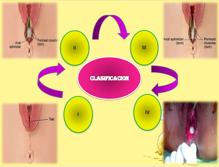 Desgarro Perineal, Cervical y vaginal - PPT