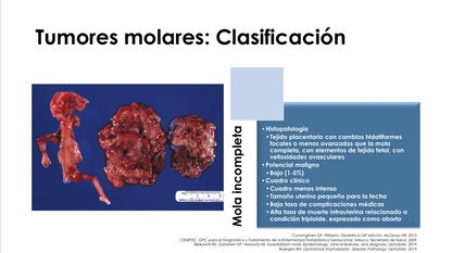 Enfermedad Trofoblástica Gestacional - PDF