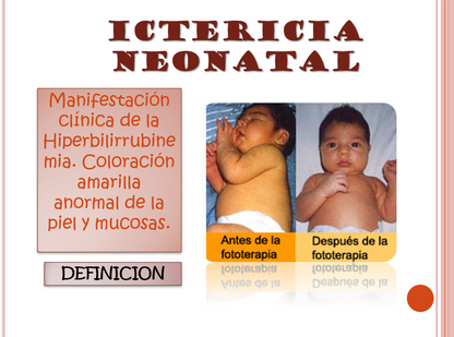 Ictericia Neonatal - PPT